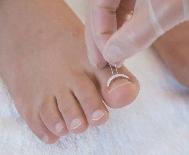 cura dell'unghia tramite metodo podofix